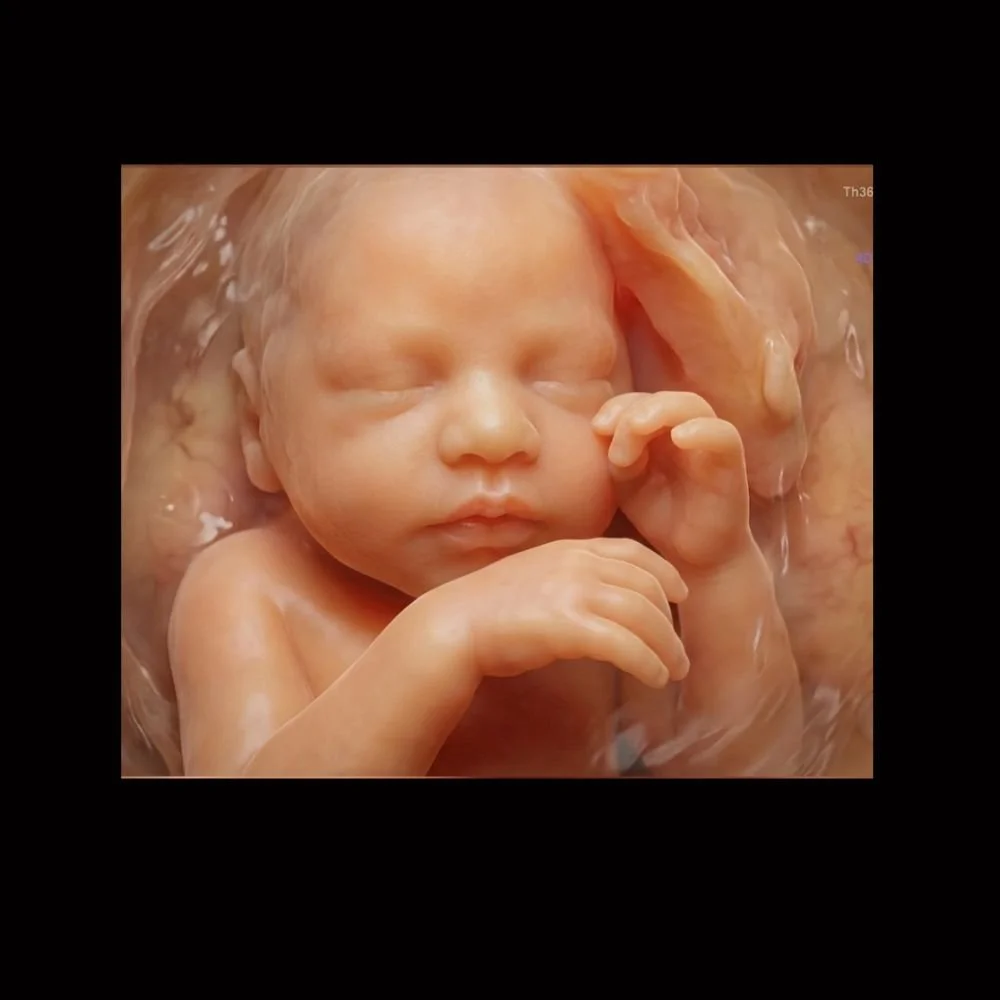 5D HD ultrasound example
