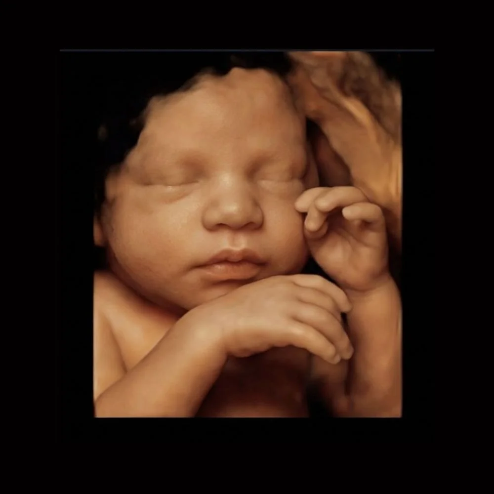 3D ultrasound example