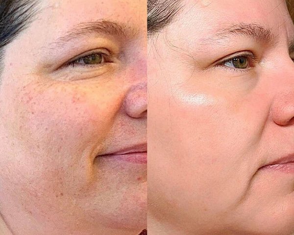 Photorejuvenation