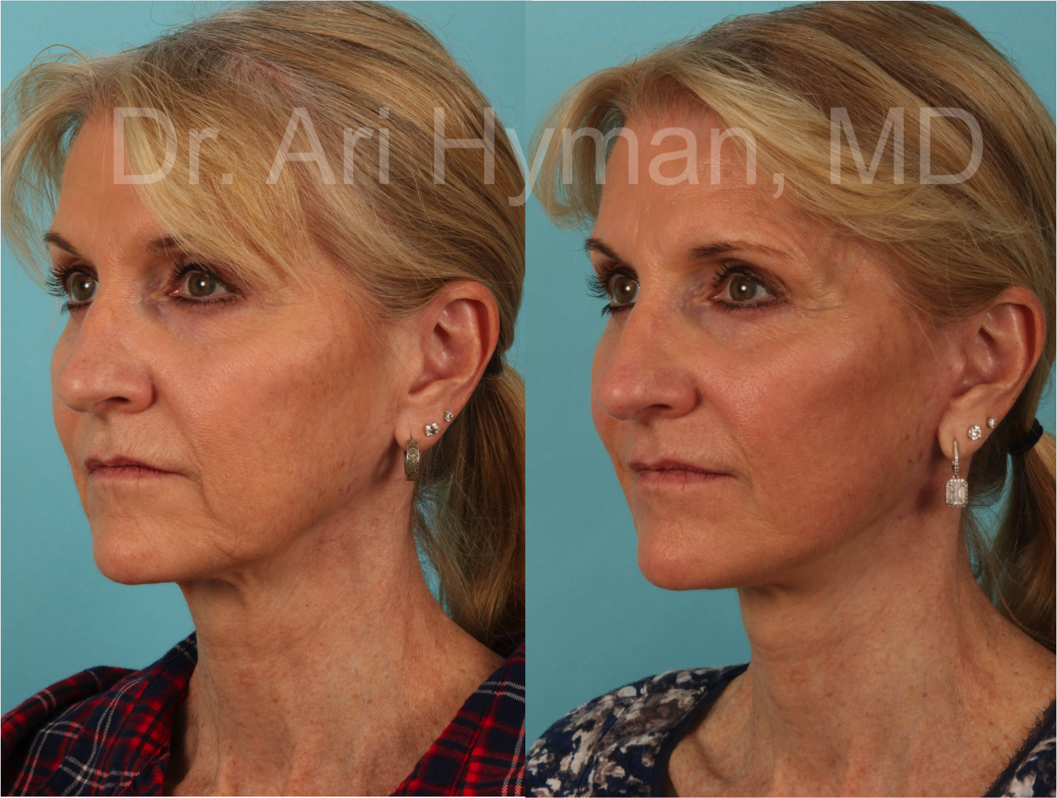before and after image of a woman's face and neck lift