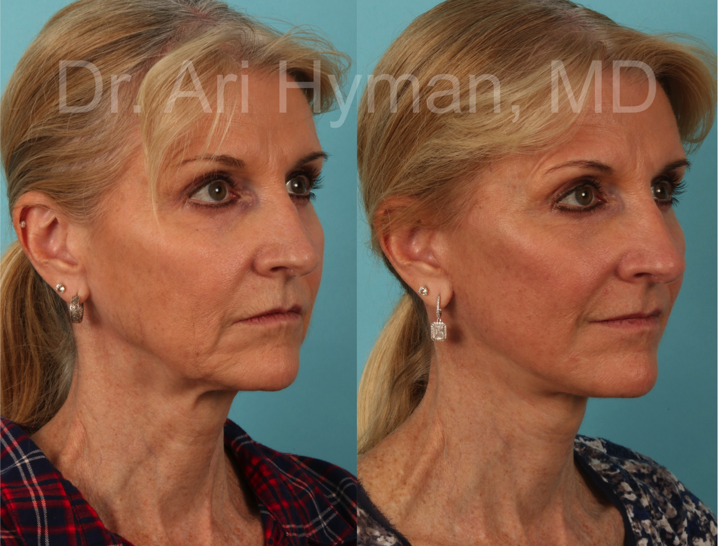 before and after image of a woman's face and neck lift