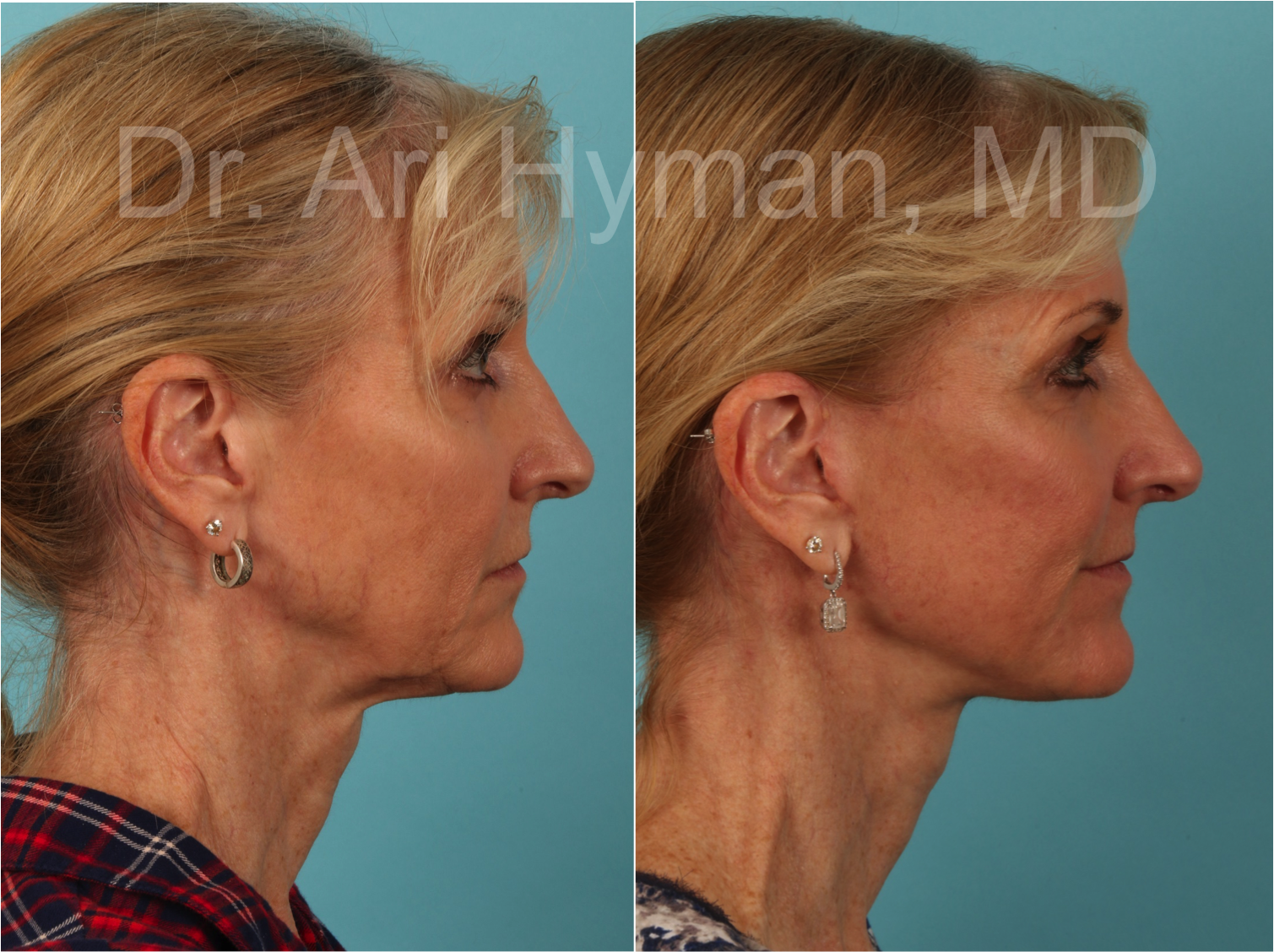 before and after image of a woman's face and neck lift