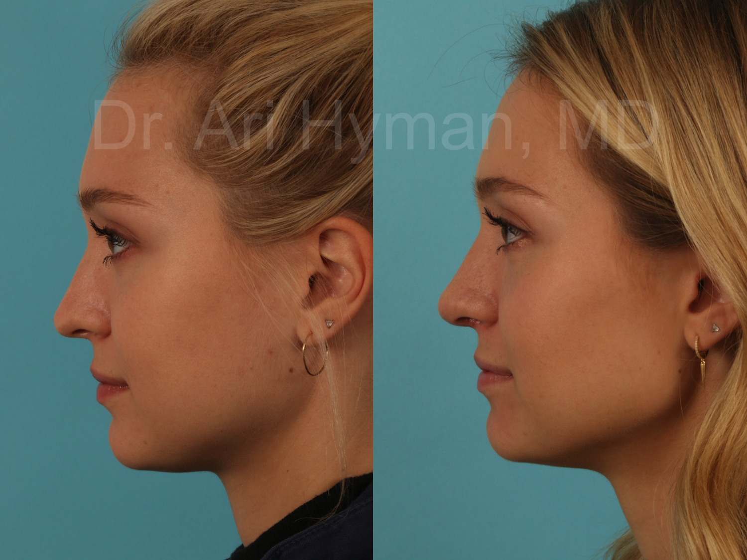 revision rhinoplasty - before and after view of woman's nose