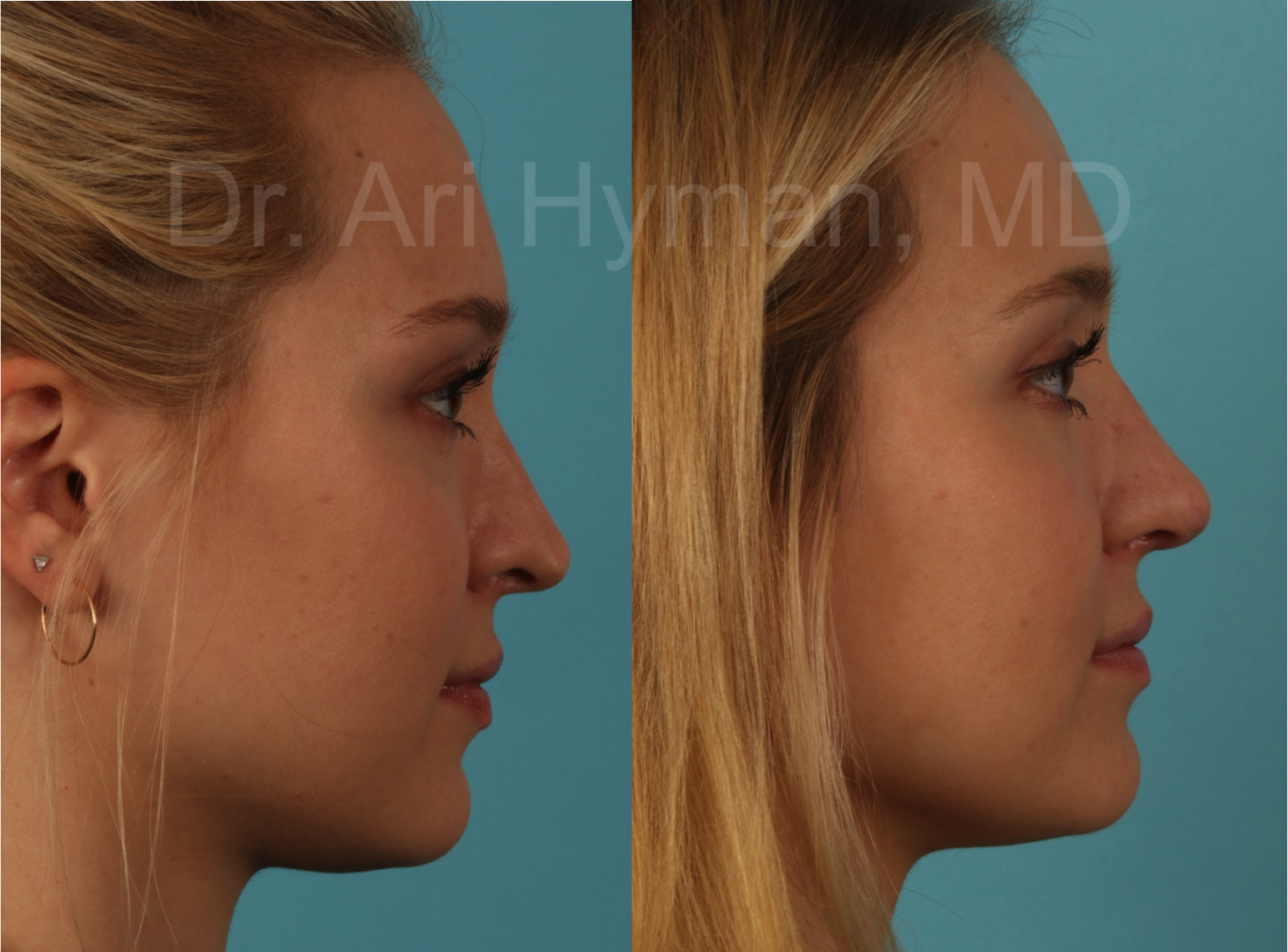 revision rhinoplasty - before and after view of woman's nose