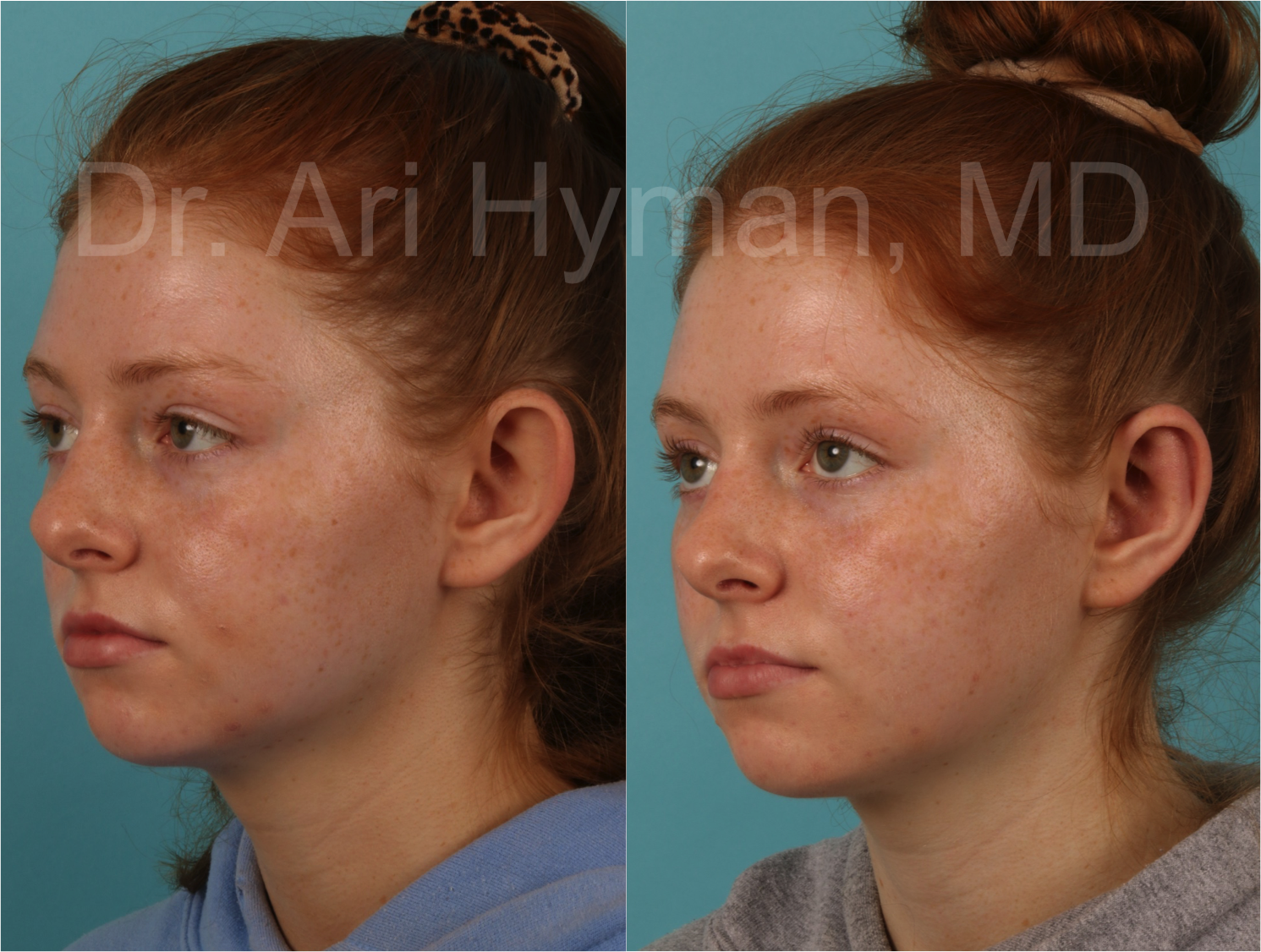 Otoplasty - before and after view of girl's ears