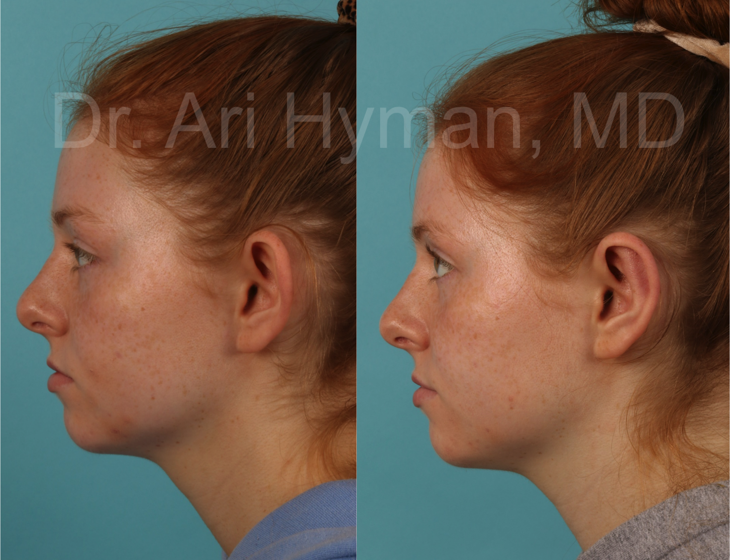Otoplasty - before and after view of girl's ears