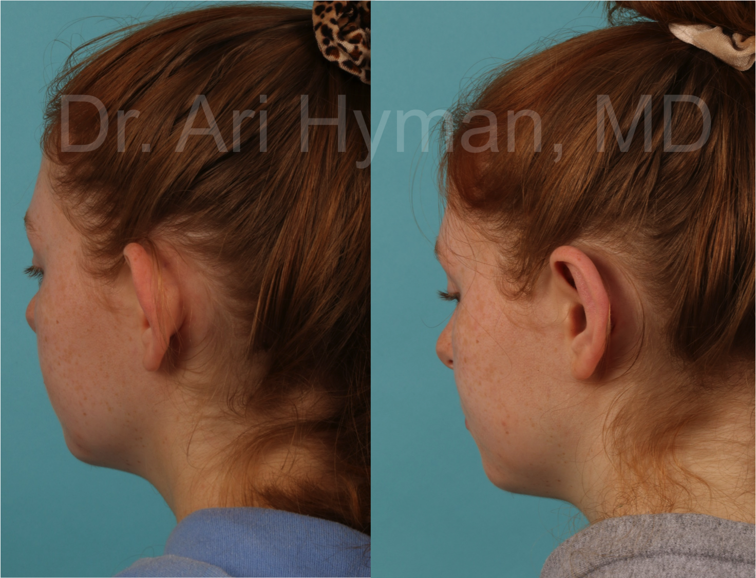 Otoplasty - before and after view of girl's ears