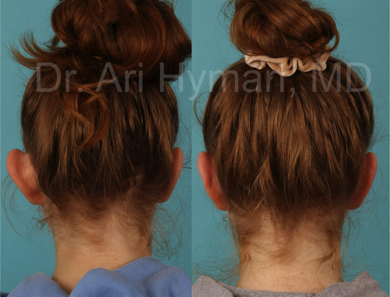 Otoplasty - before and after view of girl's ears