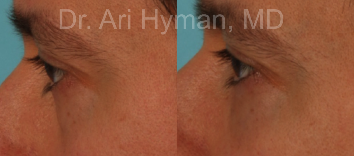 non-surgical before and after view of procedure