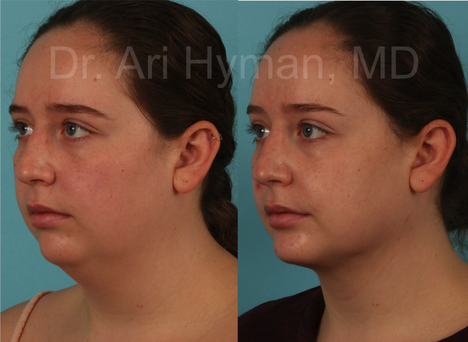 Chin and Neck Lifts - before and after view of woman's chin and neck