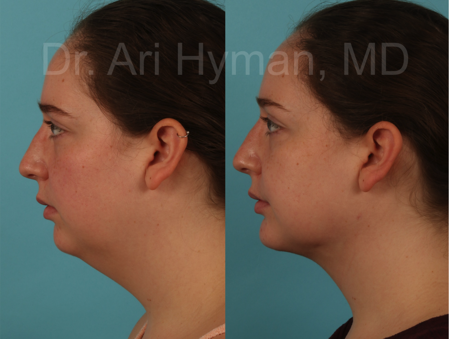 Chin and Neck Lifts - before and after view of woman's chin and neck