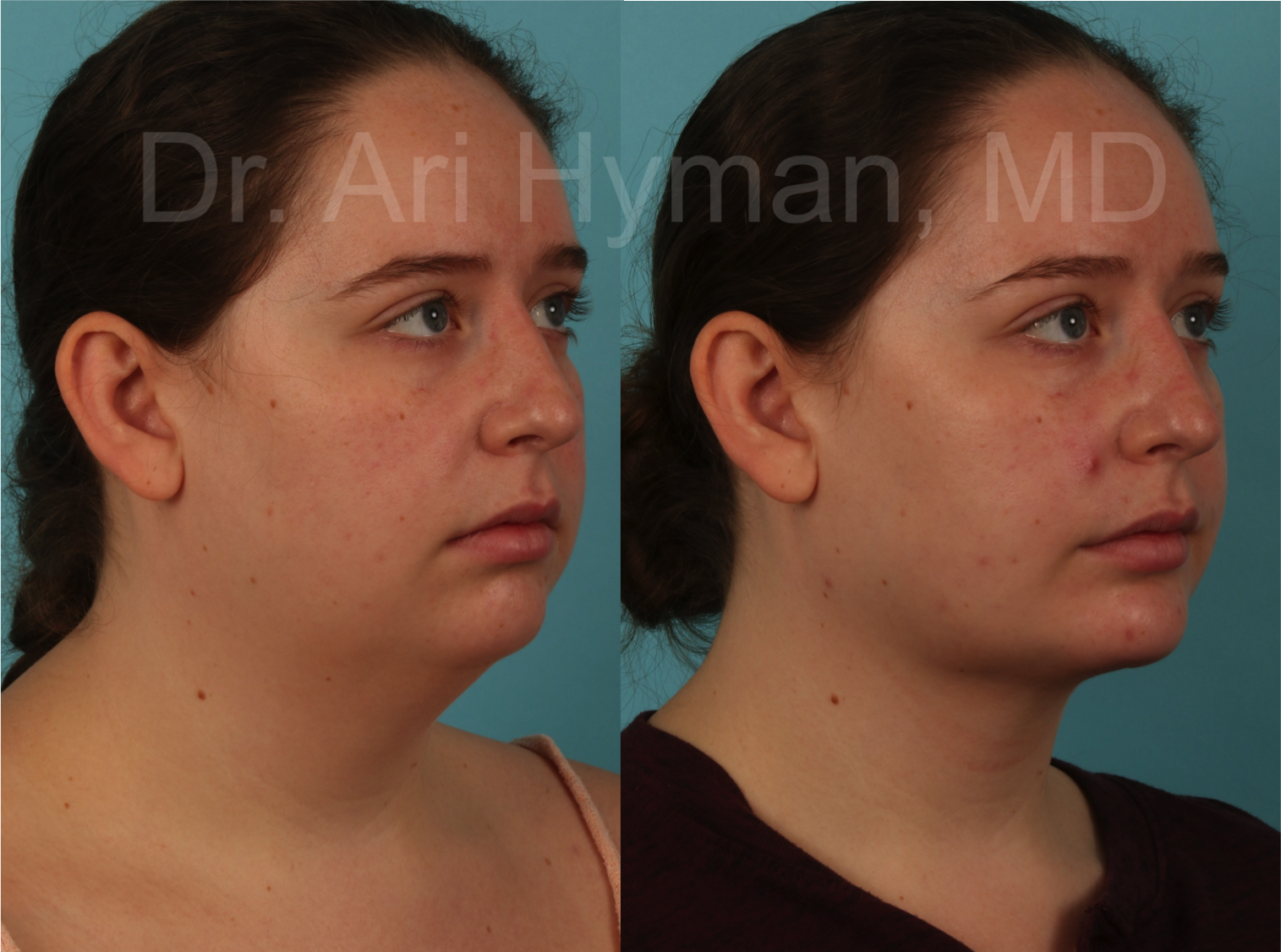 Chin and Neck Lifts - before and after view of woman's chin and neck