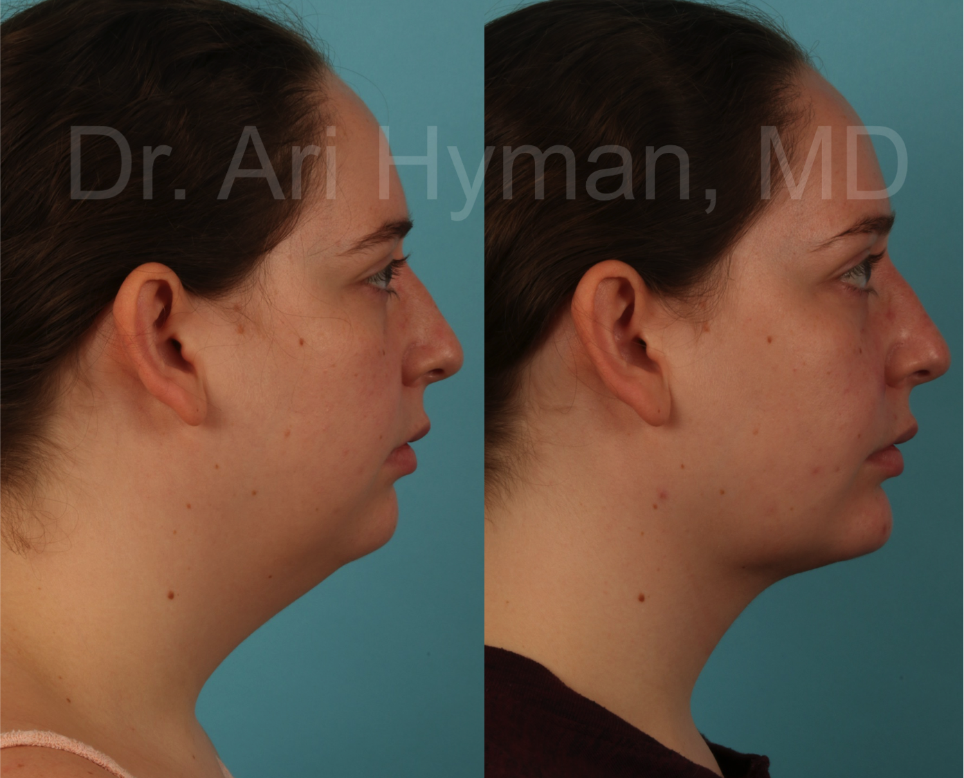 Chin and Neck Lifts - before and after view of woman's chin and neck