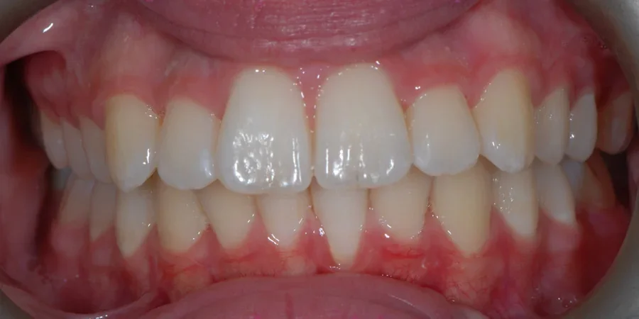 Case 1: front view of the patient’s teeth after treatment with John Kenyon