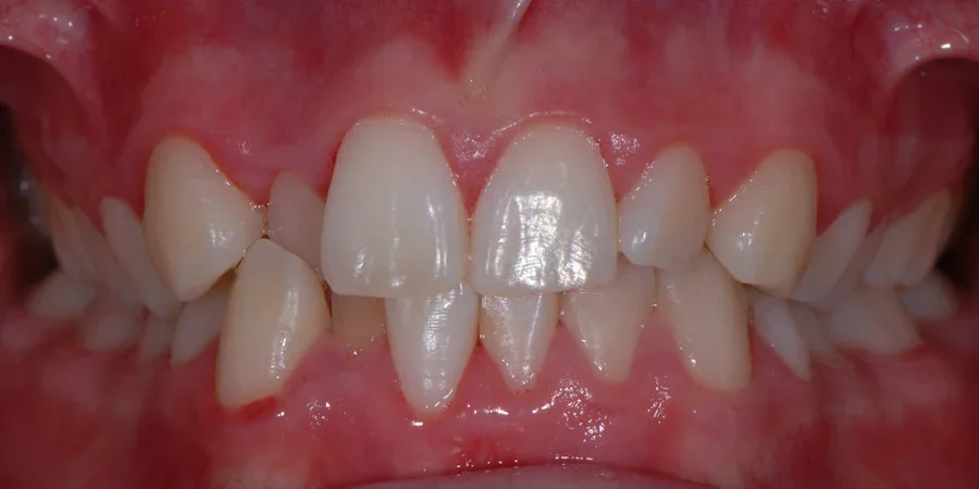 Case 2: front view of the patient’s teeth before treatment with John Kenyon