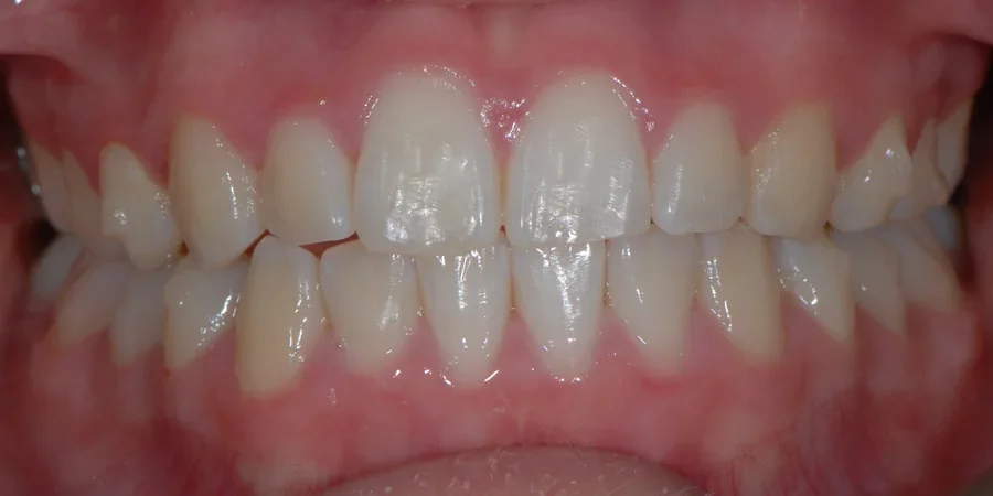 Case 2: front view of the patient’s teeth after treatment with John Kenyon