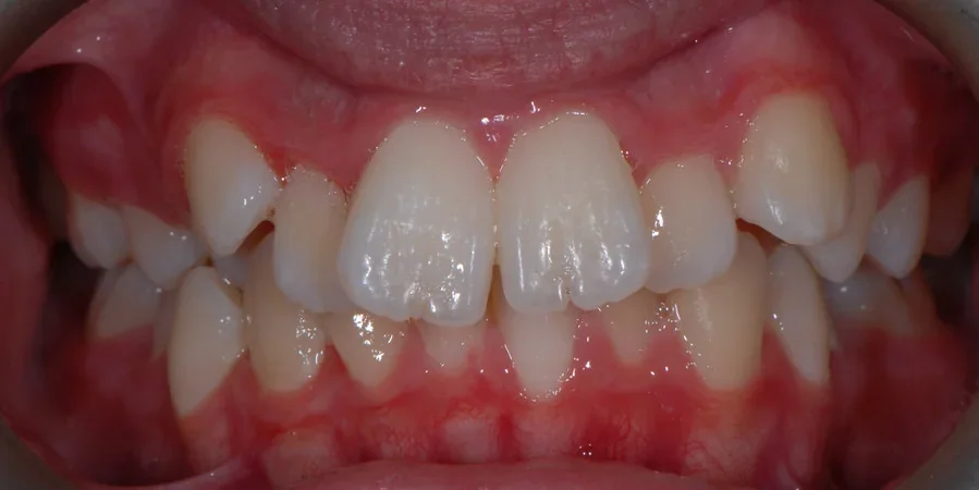 Case 1: front view of the patient’s teeth before treatment with John Kenyon