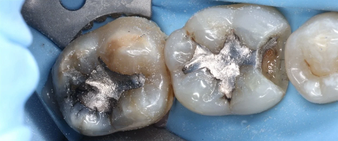 Two neighbouring back teeth with existing metal-coloured fillings before onlay treatment at iCare.
