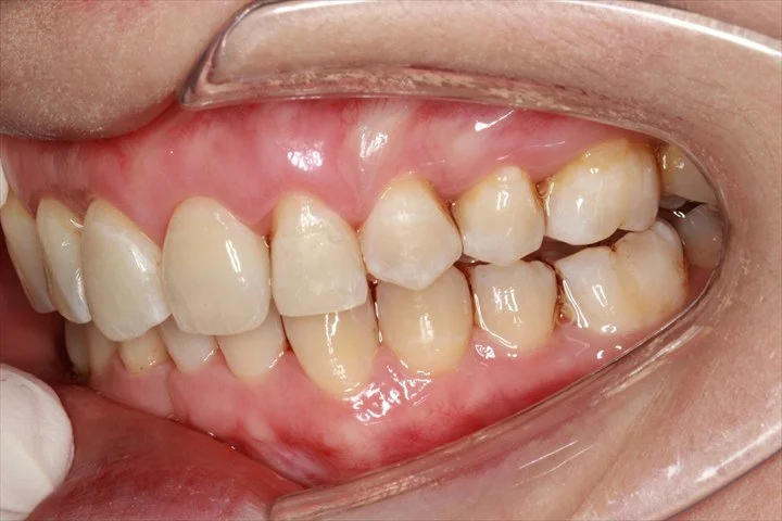 与治疗前角度相对应的 Invisalign 治疗后侧面照片，可见上颌尖牙已排列至牙弓内。