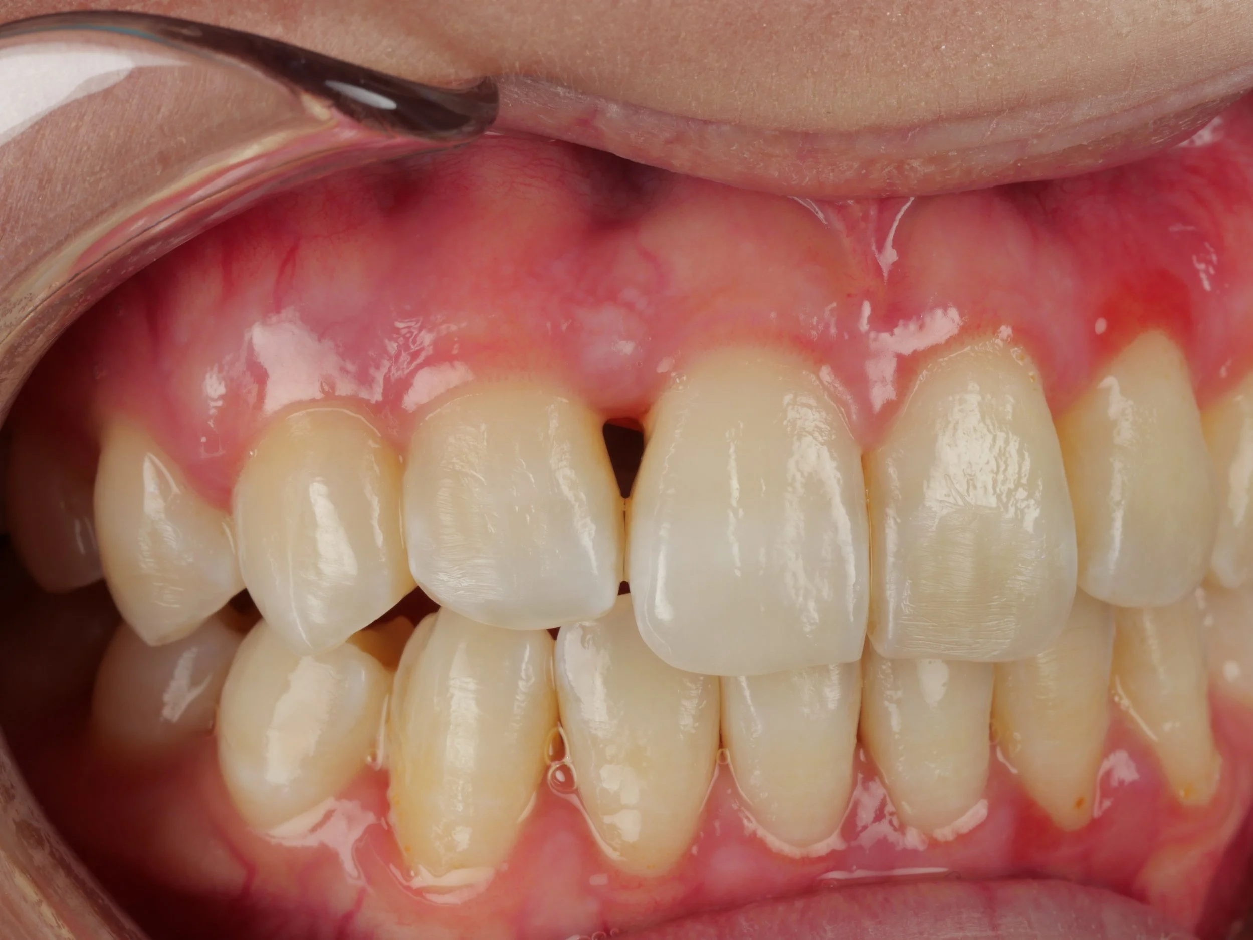 Angled close-up before Bioclear composite closure, showing a dark triangular space at the gumline between the upper front teeth.