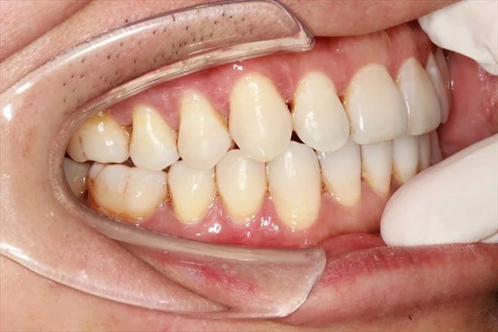 与治疗前角度相对应的 Invisalign 治疗后侧面照片，可见尖牙及前磨牙区域排列改善。