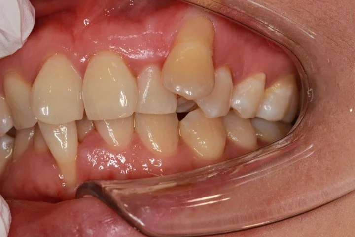Invisalign 治疗前的侧面口内照片，可见一颗上颌尖牙位于牙弓之外。