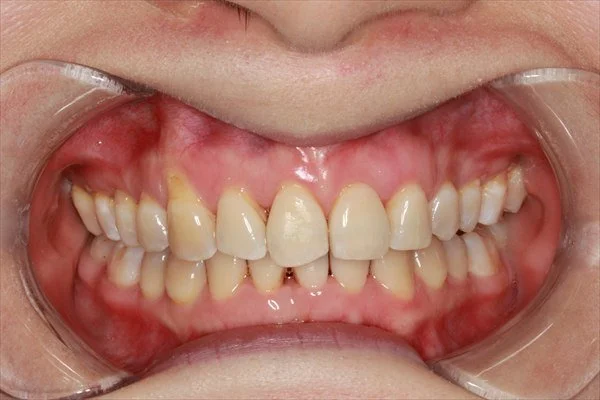 Invisalign 治疗后的正面口内照片，可见上下牙排列明显改善。