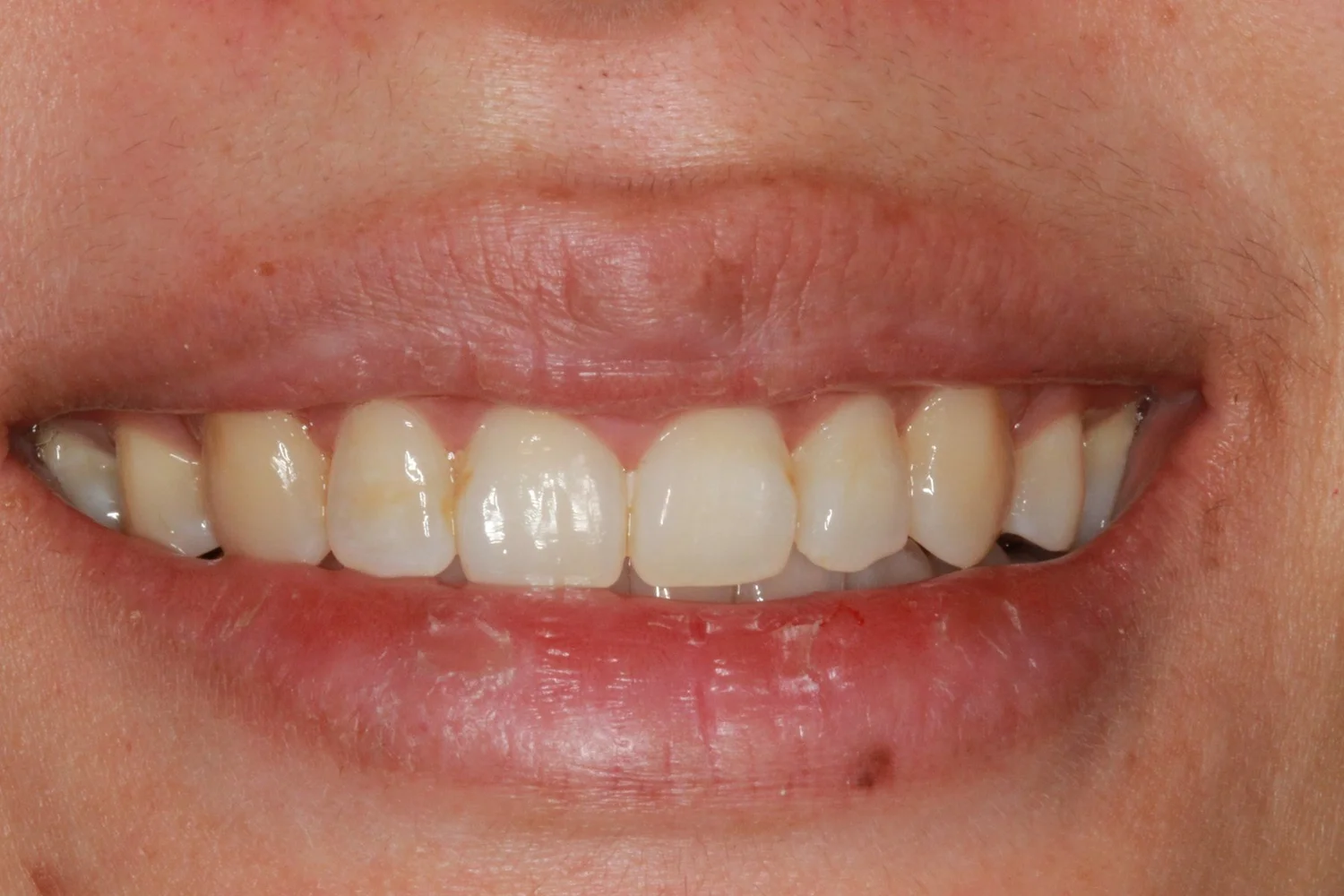 Before professional teeth whitening, showing a naturally warmer overall tooth shade.