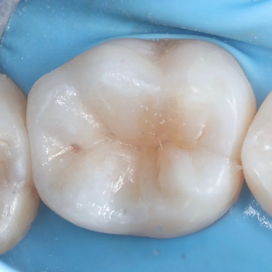 The same back tooth viewed from above after onlay restoration.