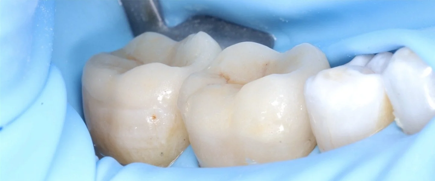 The same two back teeth after tooth-coloured onlay restorations.
