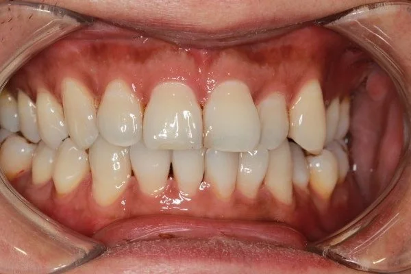 Invisalign 治疗前的正面口内照片，可见前牙拥挤和旋转。