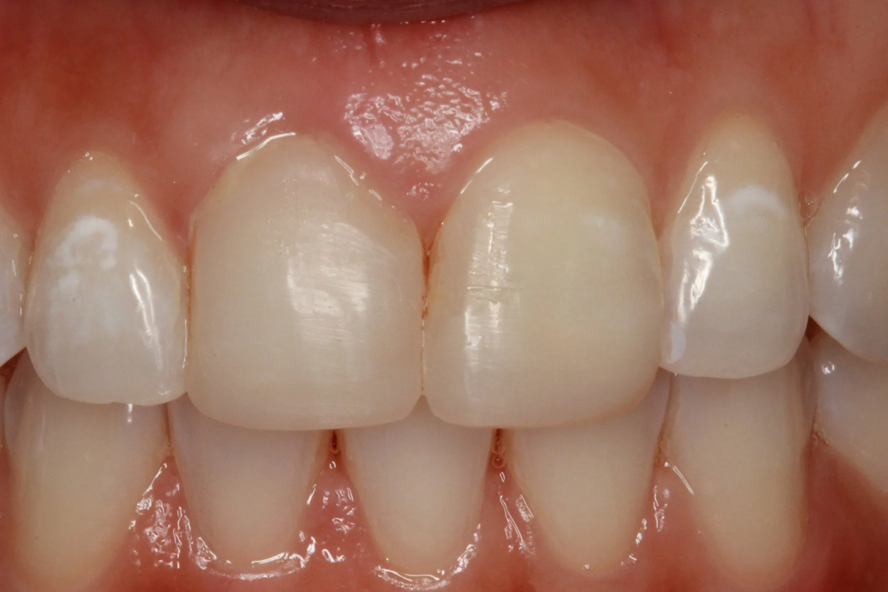 Frontal close-up of the upper front teeth after the final direct composite build-up completed at iCare Family Dental.