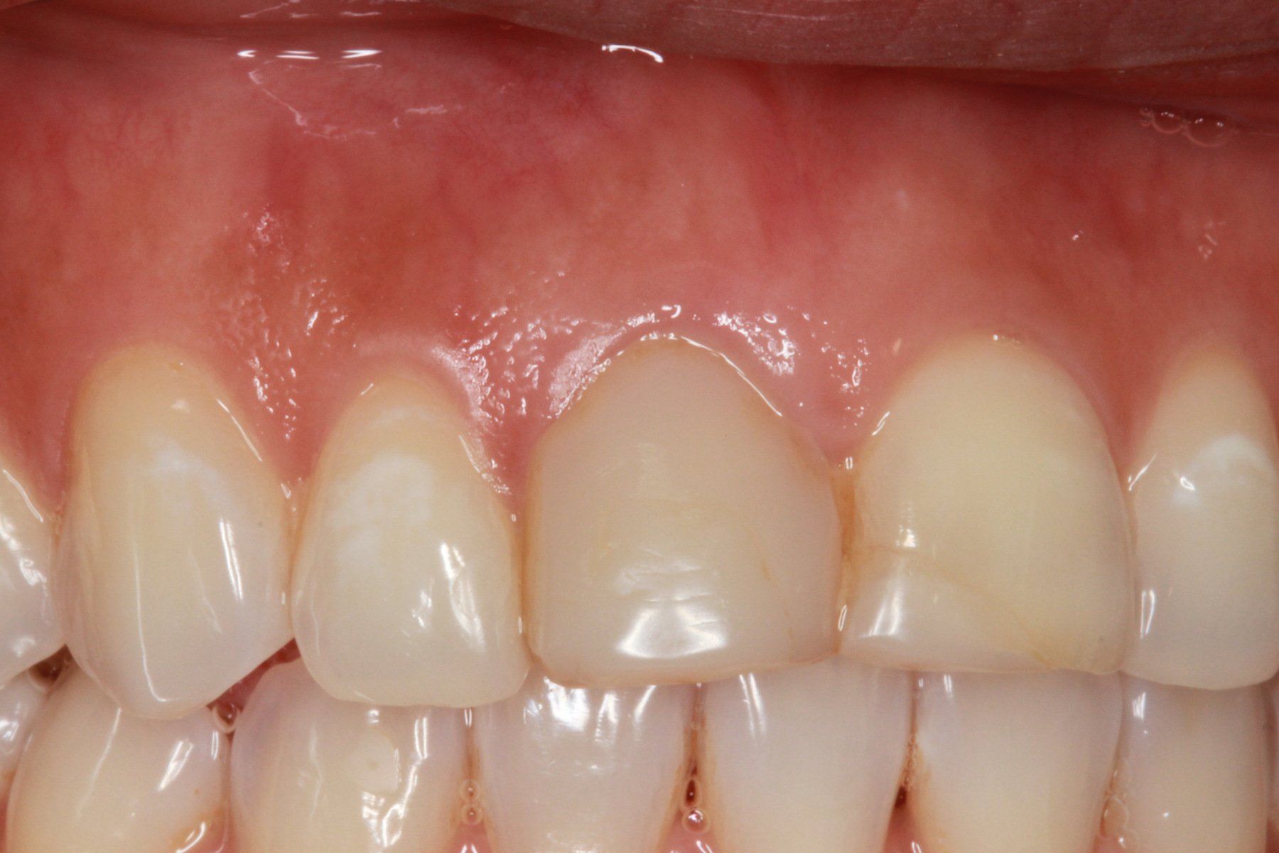 Frontal close-up of the upper front teeth before the direct composite build-up at iCare Family Dental.