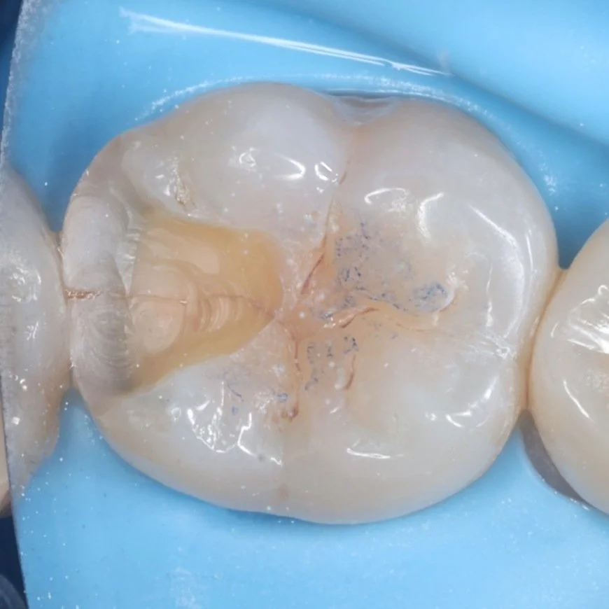 Chewing surface of a back tooth before onlay restoration at iCare.