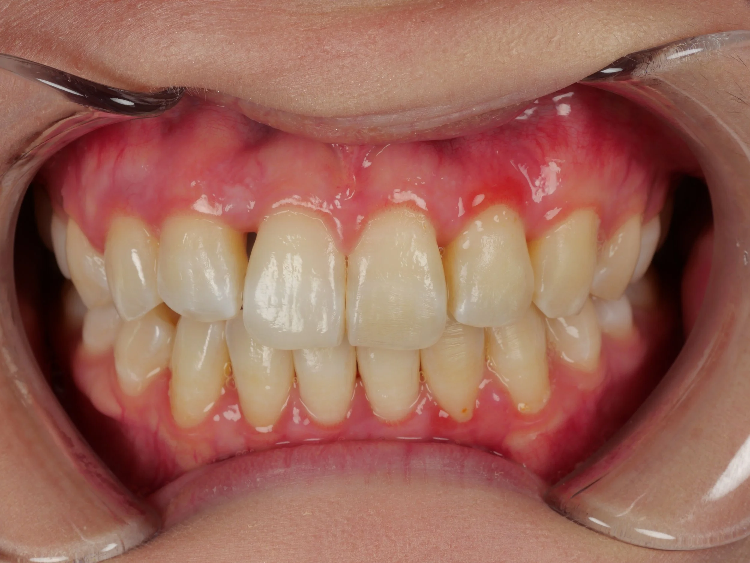 Front intraoral view before Bioclear composite closure, showing a black triangle between the upper front teeth.