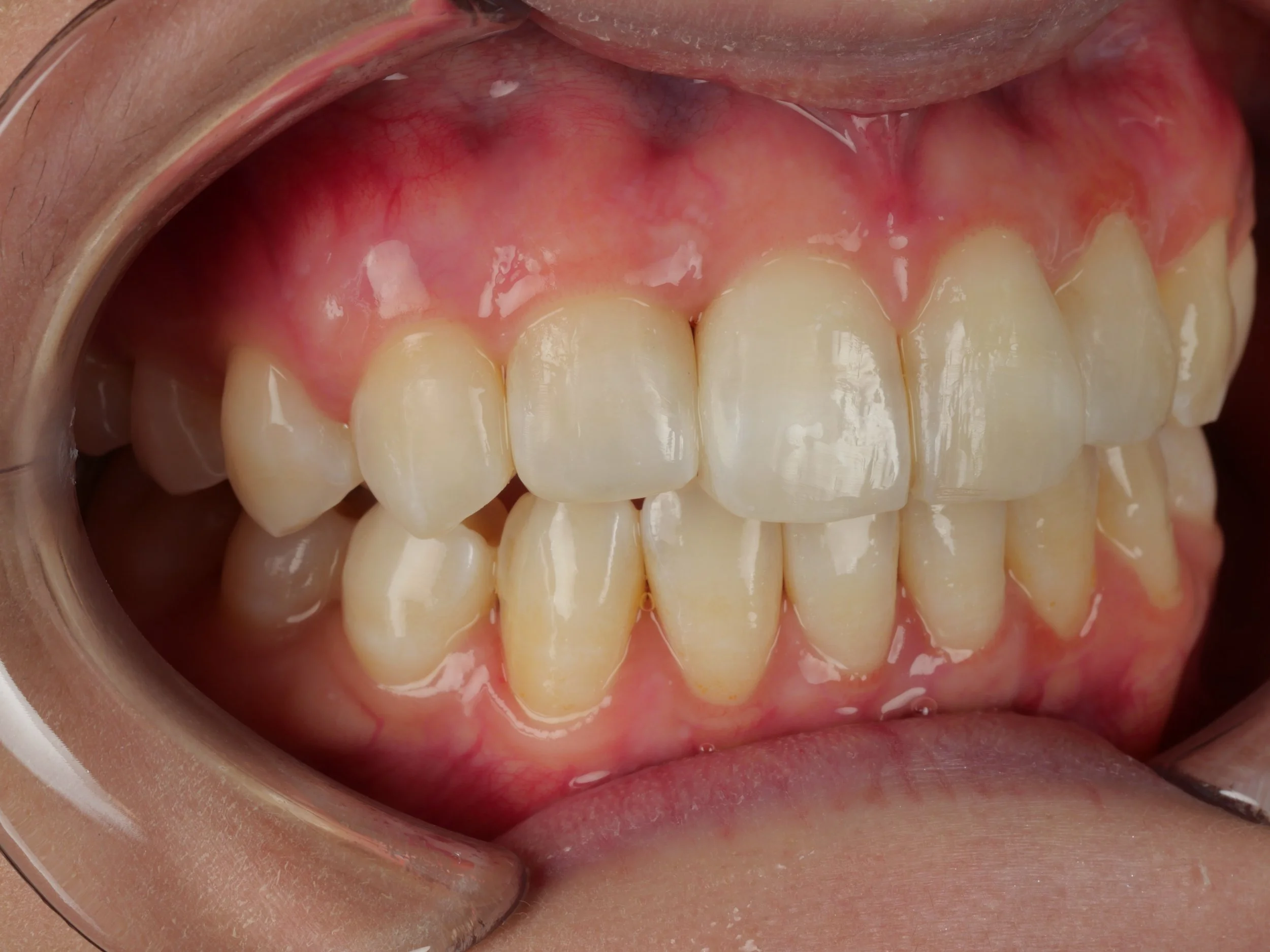 Angled close-up at the two-day review after Bioclear composite closure, showing the treated black triangle closed.