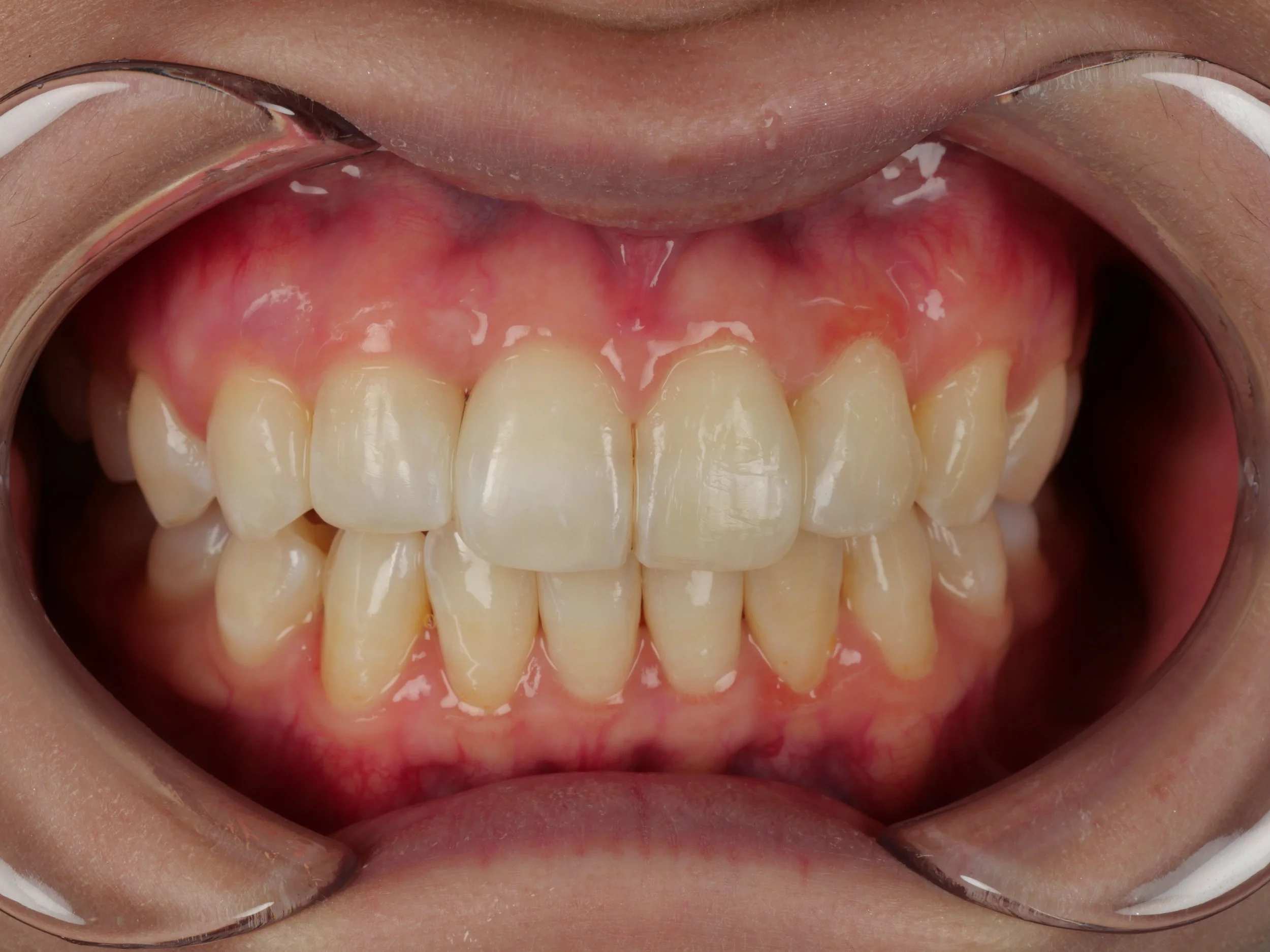 Front intraoral view at the two-day review after Bioclear composite closure, showing the treated black triangle closed.