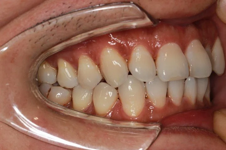 Invisalign 治疗前的侧面口内照片，可见尖牙及前磨牙区域的牙齿拥挤。