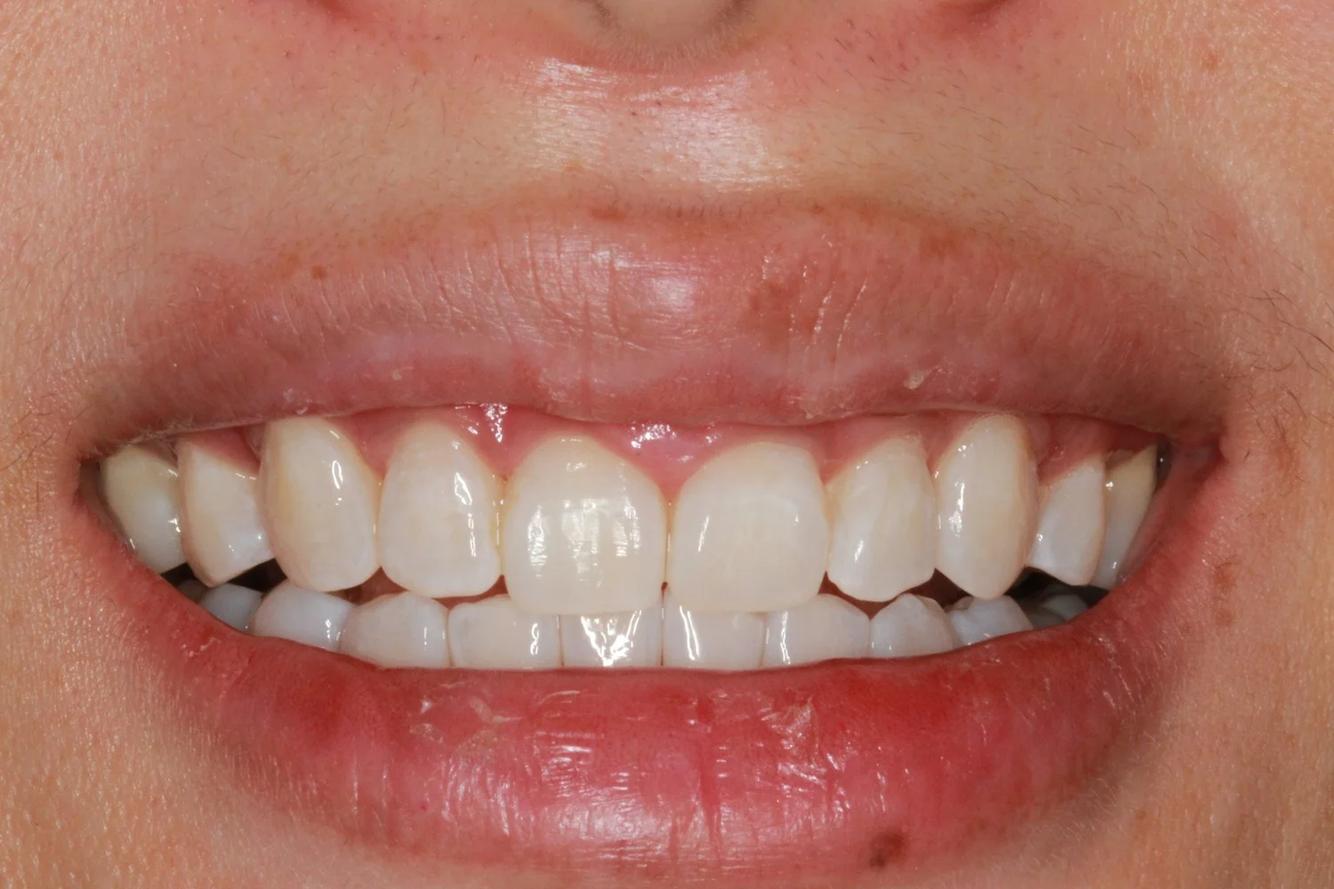 After professional teeth whitening, showing the same smile with a lighter overall shade.