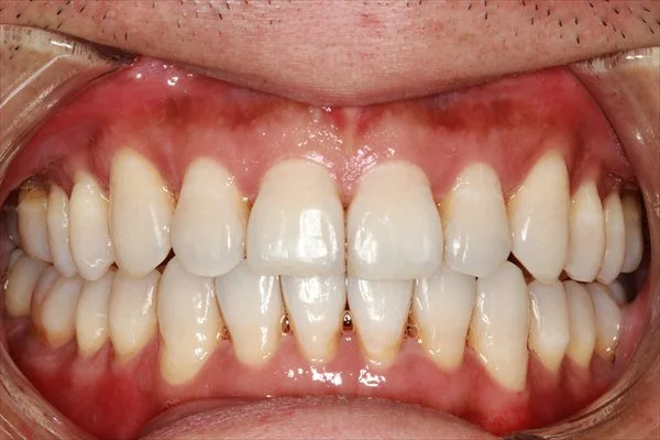 Invisalign 治疗后的正面口内照片，可见前牙排列明显改善。