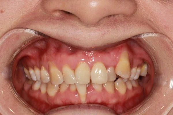 Invisalign 治疗前的正面口内照片，可见明显牙齿拥挤及位置较高的上颌尖牙。