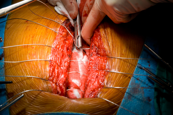Chest and sternal reconstructive surgery