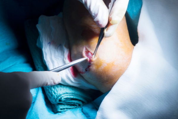 Limb salvage surgery