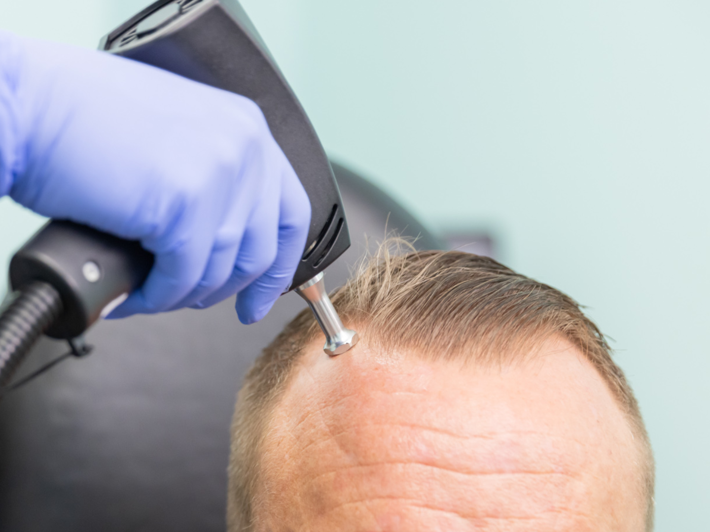 Alma TED transdermal ultrasound device applied to scalp for non-invasive hair restoration