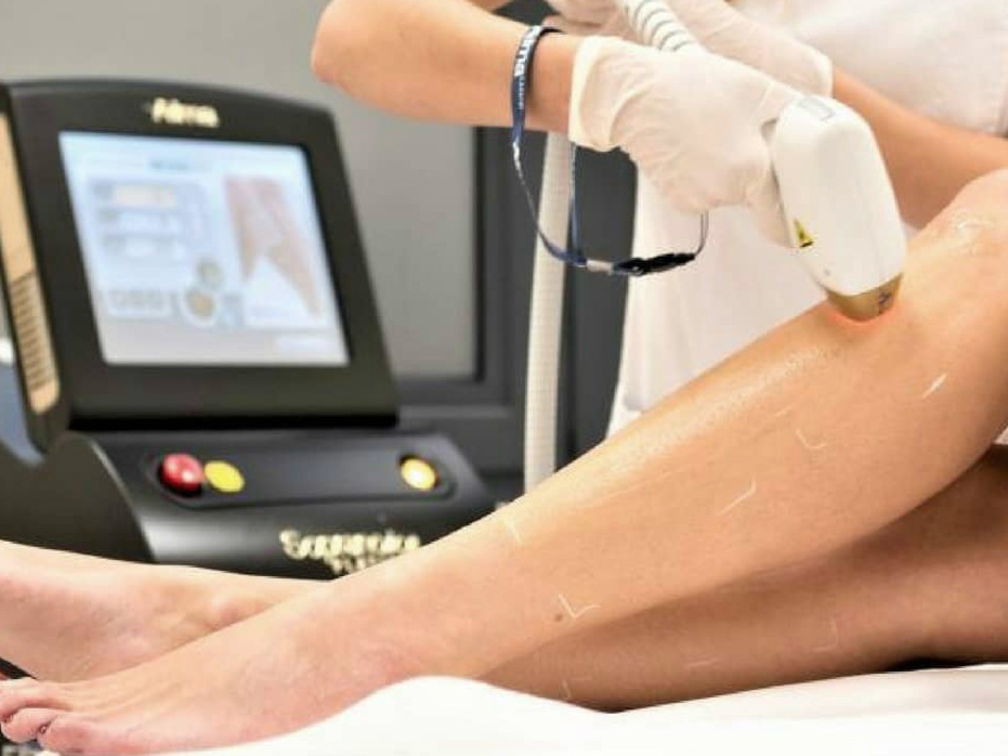 Soprano Titanium laser hair removal treatment on the leg at SageMED in Bellevue