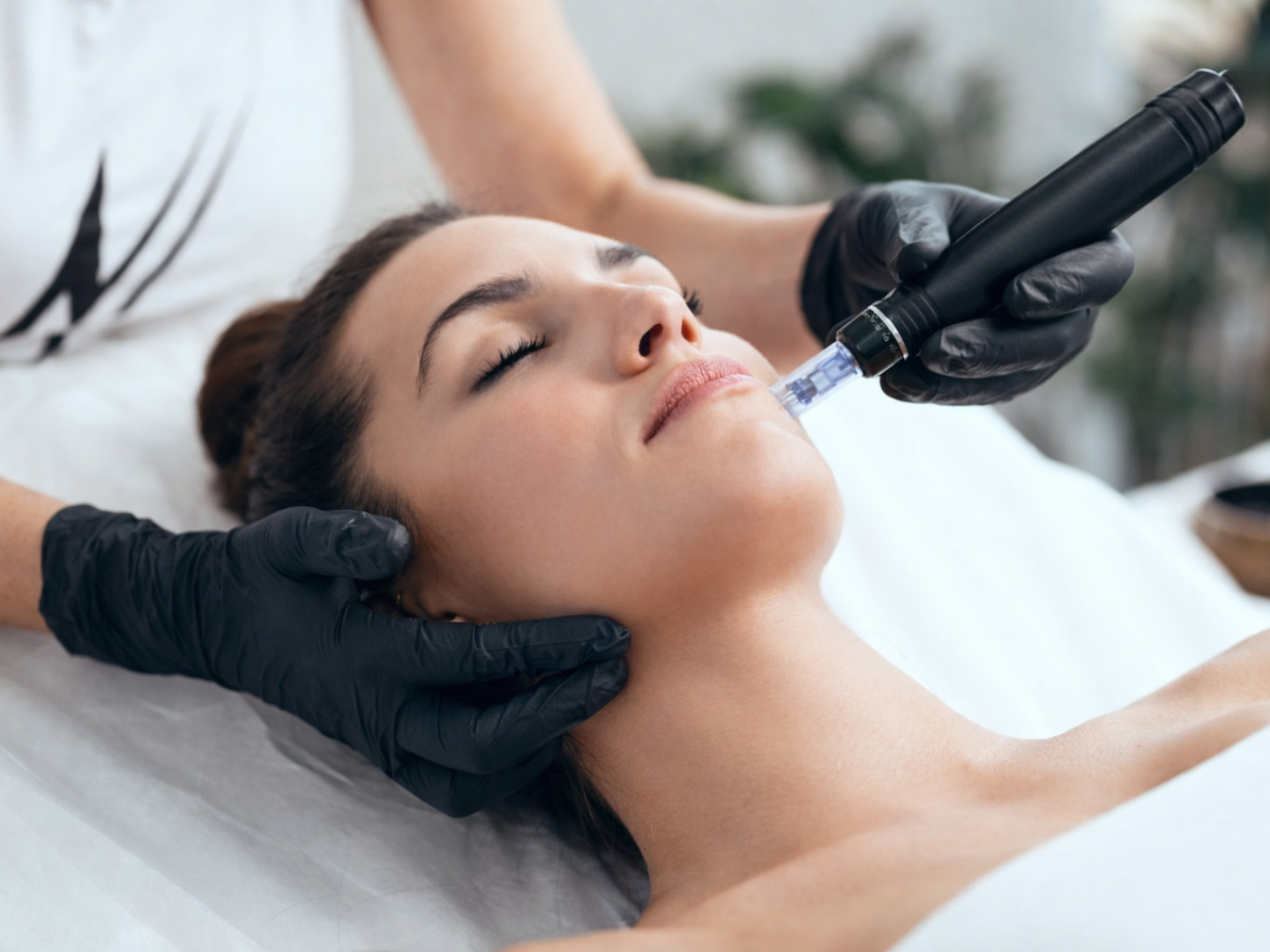 Collagen P.I.N. microneedling results showing improved skin texture, reduced acne scars, and smoother complexion