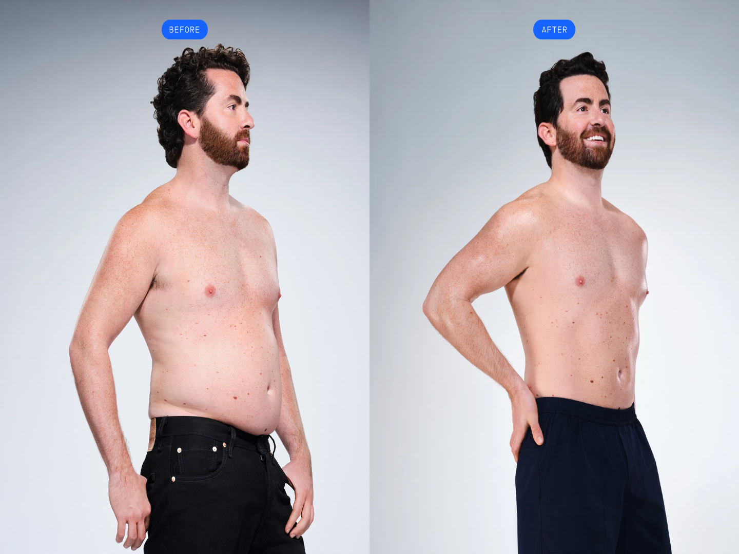 CoolSculpting before and after results highlighting visible fat reduction and improved abdominal contour (side view)