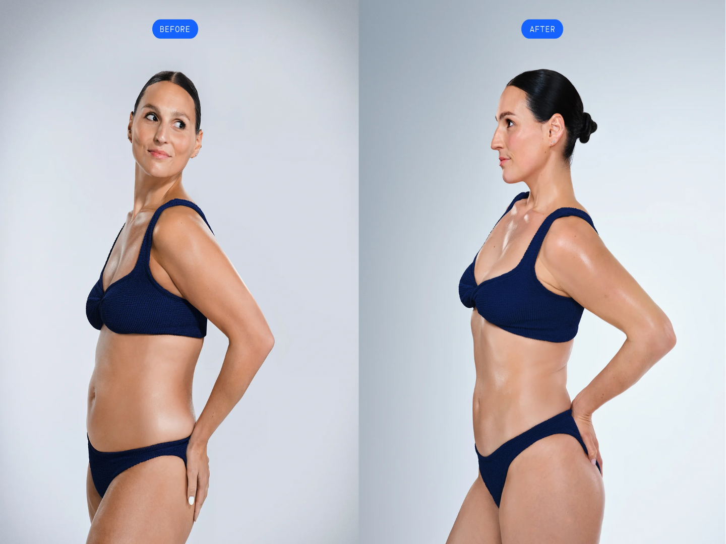 CoolSculpting before and after results showing visible fat reduction and improved body contour