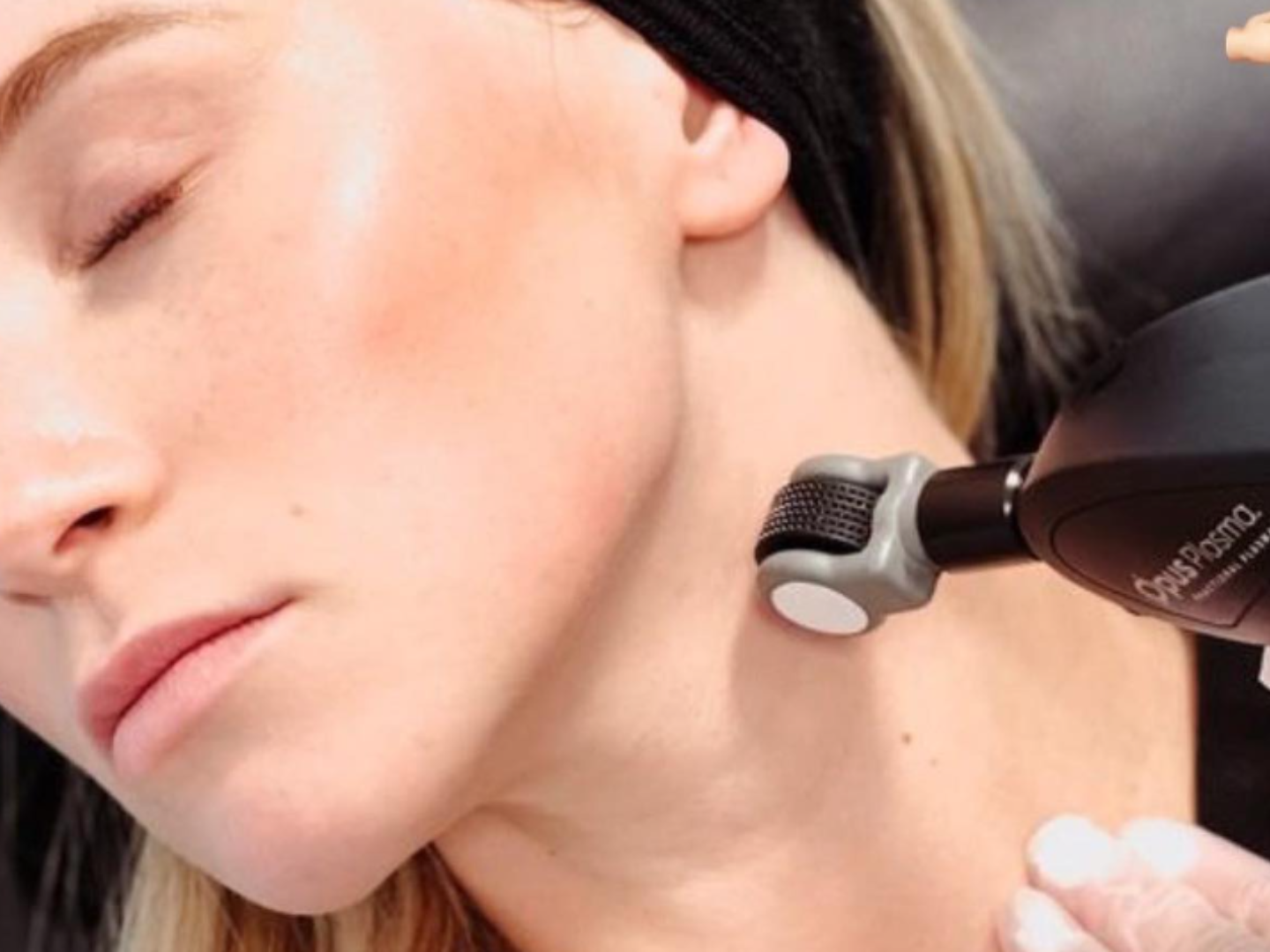 Opus Plasma® results showing improved skin texture, reduced fine lines, and smoother complexion