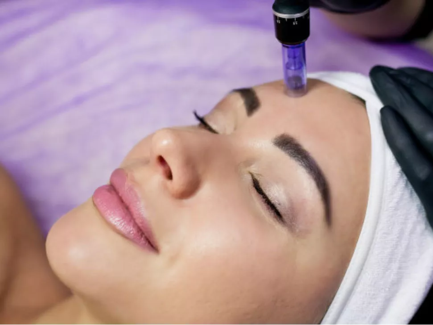 Collagen P.I.N. microneedling treatment at SageMED showing improved skin texture and tone